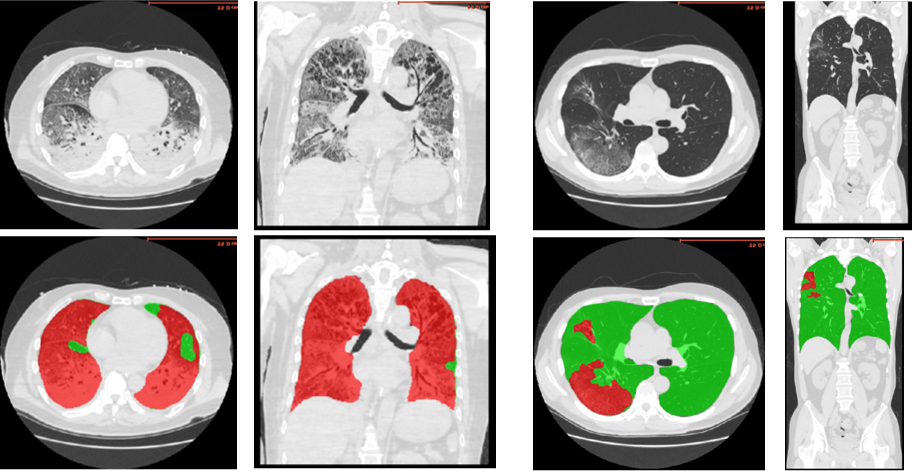 Lung segmentation from CT volume with AI